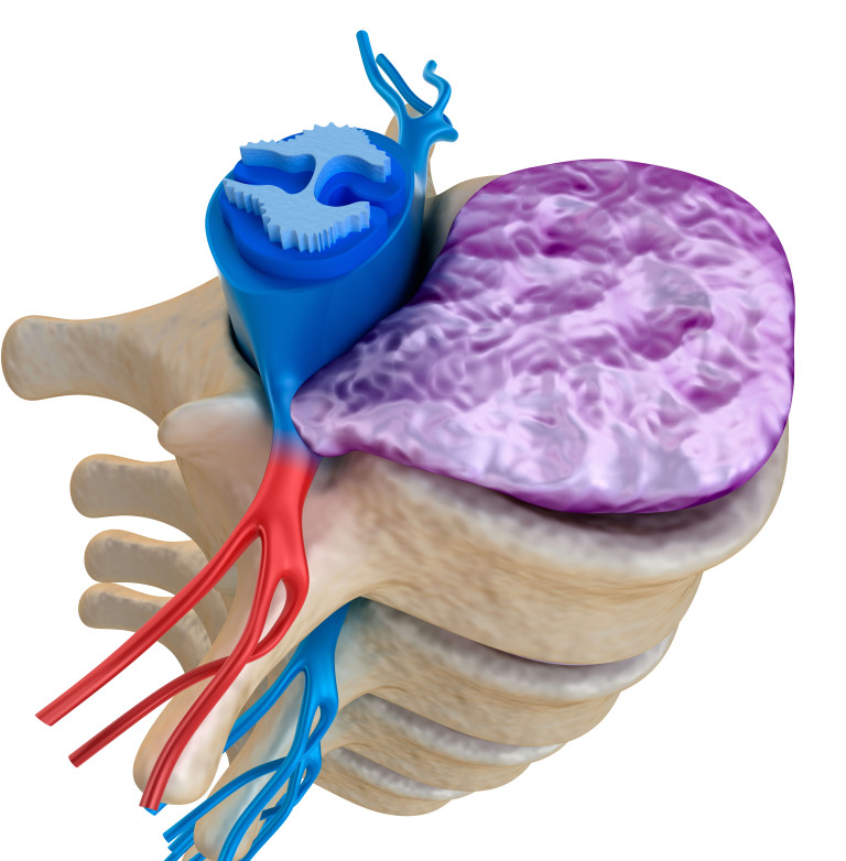 Pinched Nerve Keystone Spine And Pain Management Center Wyomissing 