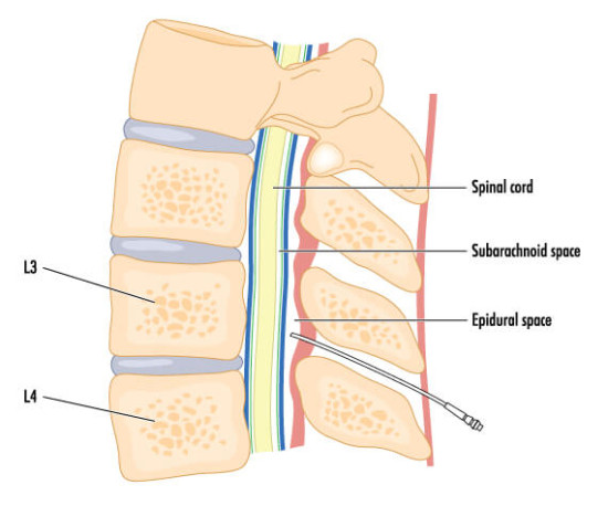 Epidural Steroid Injections Keystone Spine And Pain Management Center 