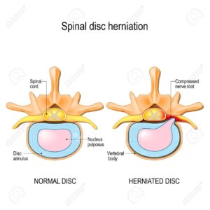 spinal-disc-herniation